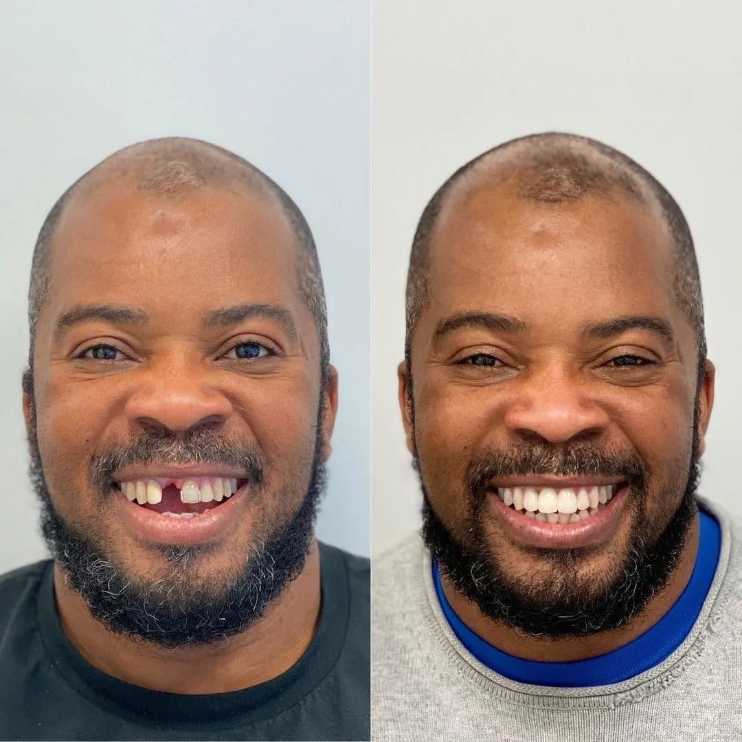 A patient of Centre Dentaire Mawlawi before and after treatment, side by side